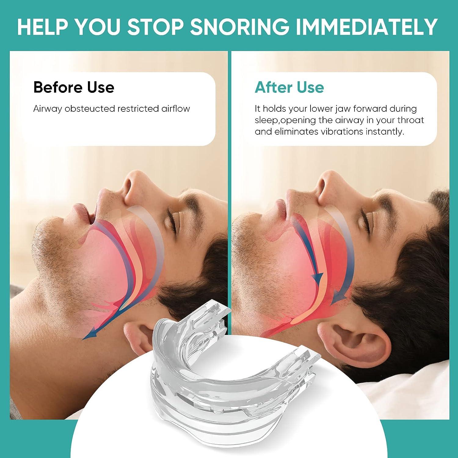 Anti-Snoring Mouthpiece – Comfortable Sleep Support Device