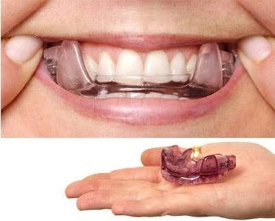 Anti-Snoring Mouthpiece – Comfortable Sleep Support Device